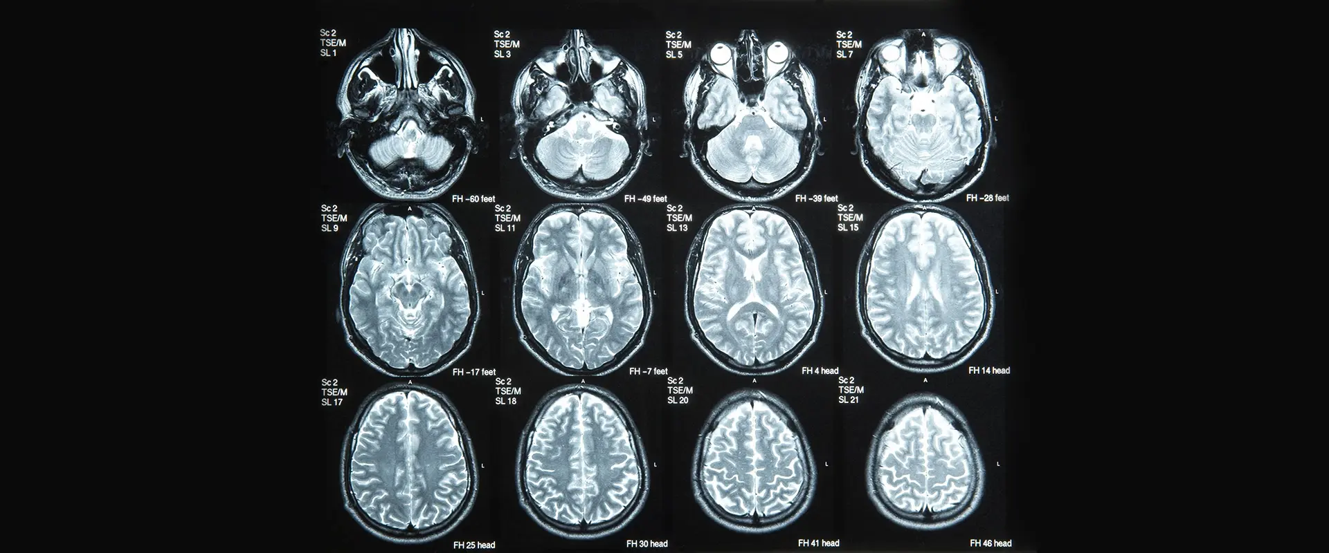 A series of mri images showing the brain.